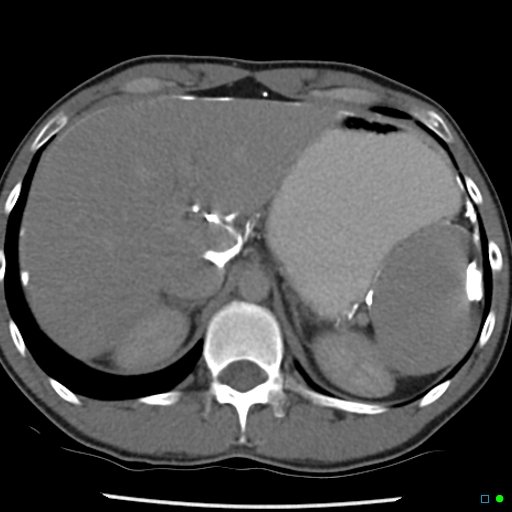 File:Chronic barium peritonitis and small bowel obstruction (Radiopaedia 29151-29548 D 2).jpg