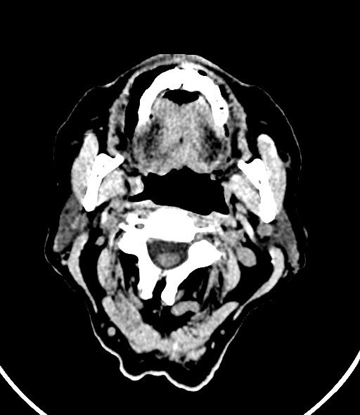 Chronic bilateral subdural hygroma (Radiopaedia 85801-101623 Axial non-contrast 66).jpg