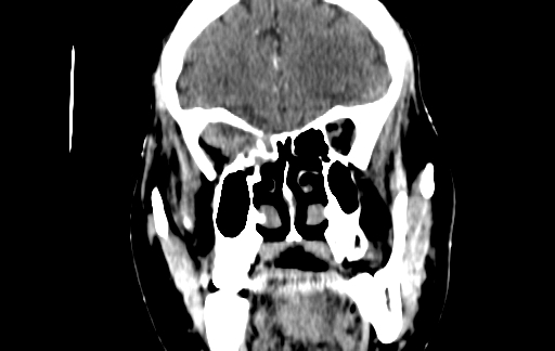 Chronic invasive fungal sinusitis (Radiopaedia 91563-109286 D 51).jpg
