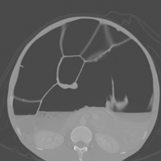 File:Chronic large bowel pseudo-obstruction (Radiopaedia 43181-46492 Axial bone window 81).jpg