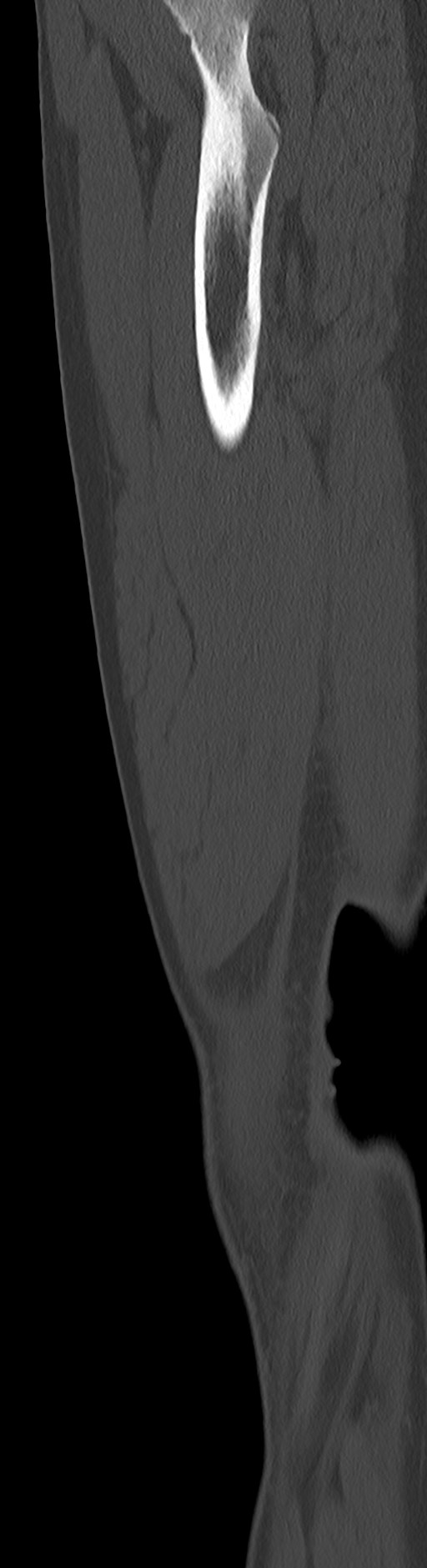 Chronic ostemyelitis of the femur with long sinus tract (Radiopaedia 74947-85982 Sagittal bone window 31).jpg