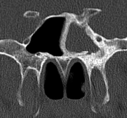 File:Chronic sphenoidal sinusitis and osteomyelitis (Radiopaedia 14037).jpg