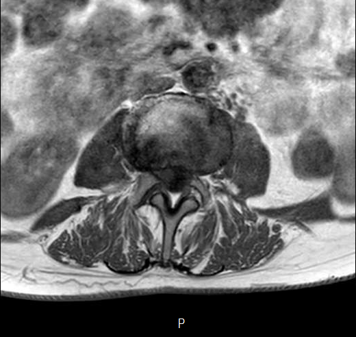 File:Chronic spinal hematoma with cauda equina syndrome (Radiopaedia 75745-87090 Axial T1 14).png