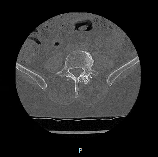 File:Chronic spinal hematoma with cauda equina syndrome (Radiopaedia 75745-88197 Axial bone window 55).png