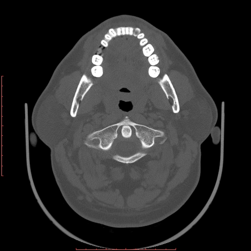 File:Chronic submandibular sialolithiasis (Radiopaedia 69817-79814 Axial bone window 32).jpg