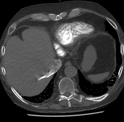 File:Chronic thromboembolic pulmonary disease (Radiopaedia 90694-108119 Axial C+ CTPA 80).jpg