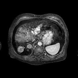 Cirrhosis and hepatocellular carcinoma in the setting of hemochromatosis (Radiopaedia 75394-86594 Axial T1 C+ fat sat 227).jpg