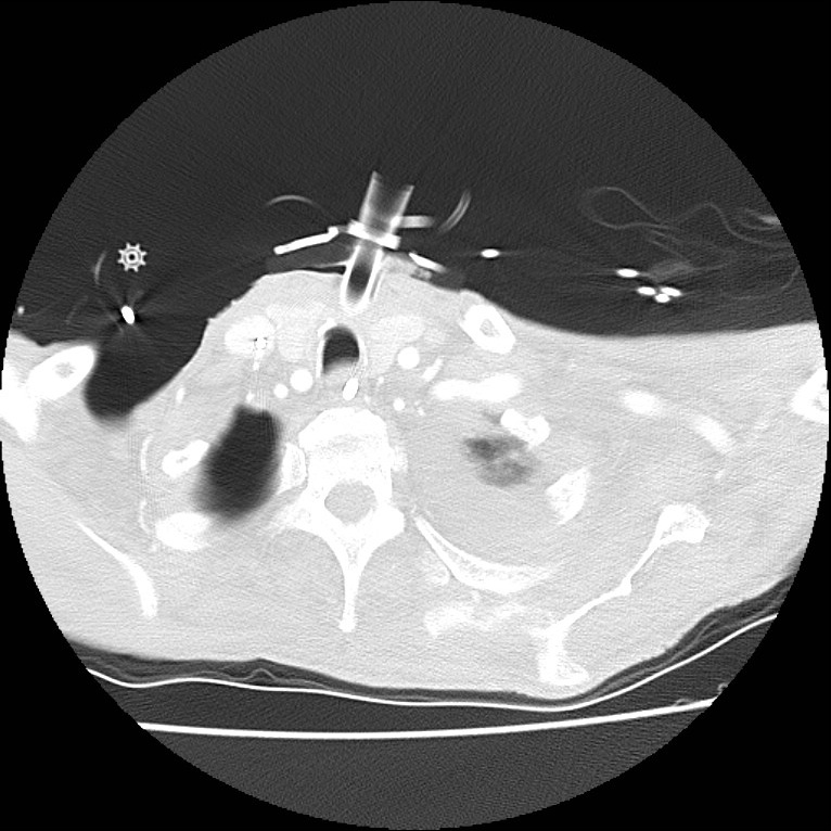 Clagett thoracotomy with bronchopleural fistula (Radiopaedia 29192-29587 Axial lung window 1).jpg
