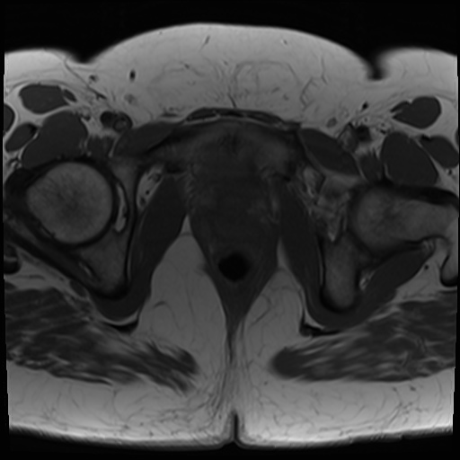 File:Class II Mullerian duct anomaly- unicornuate uterus with rudimentary horn and non-communicating cavity (Radiopaedia 39441-41755 Axial T1 24).jpg