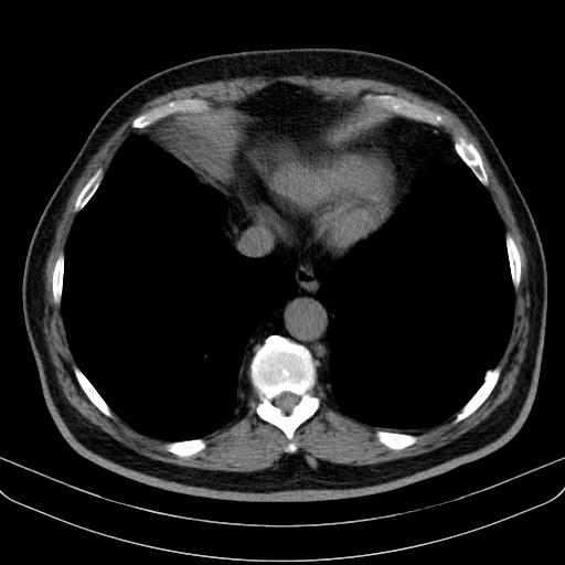 File:Classic complicated silicosis (Radiopaedia 49720-54961 Axial liver window 44).jpg