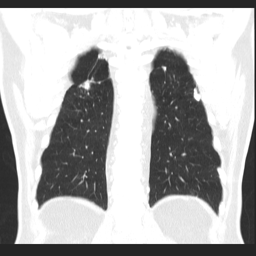 File:Classic complicated silicosis (Radiopaedia 49720-54961 Coronal lung window 50).jpg