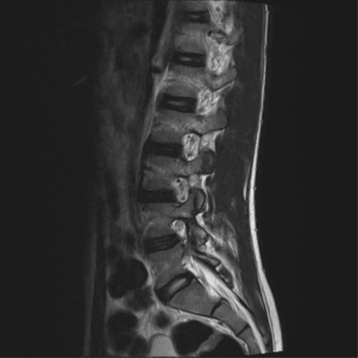 File:Clear cell meningoma - lumbar spine (Radiopaedia 60116-67690 Sagittal T2 12).png