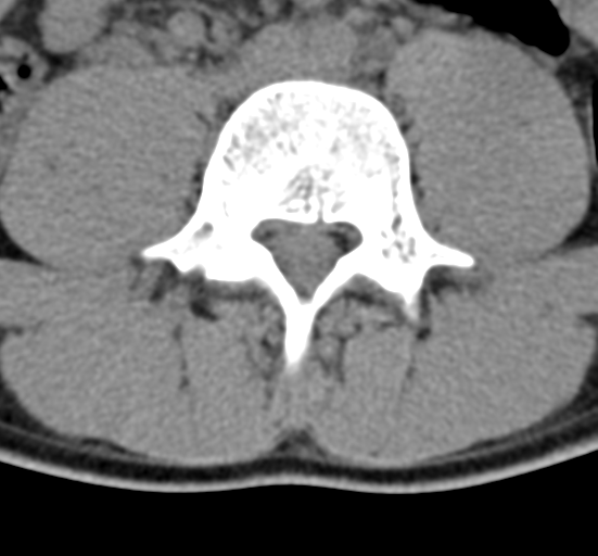 Clear cell meningoma - lumbar spine (Radiopaedia 60116-67691 Axial non-contrast 49).png