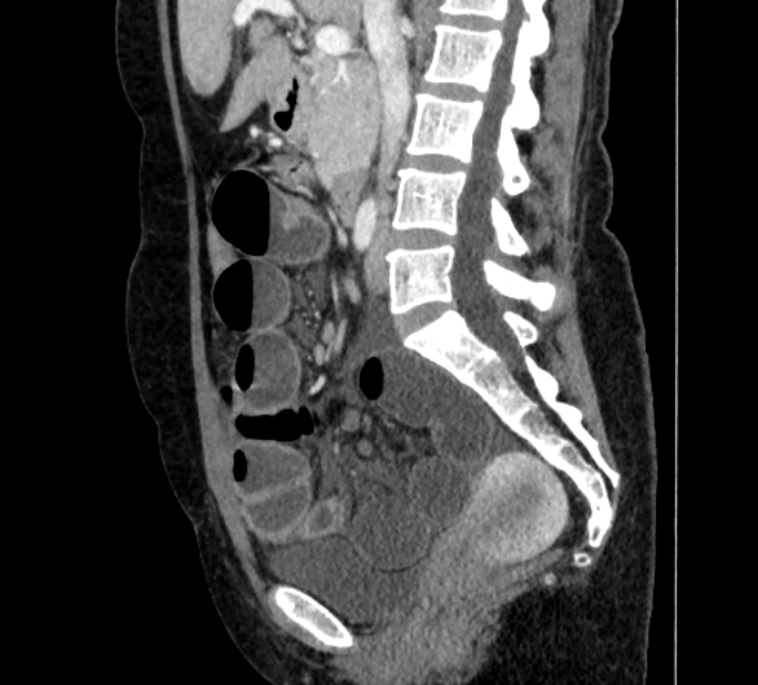 Closed loop small bowel obstruction (Radiopaedia 71211-81508 C 68).jpg