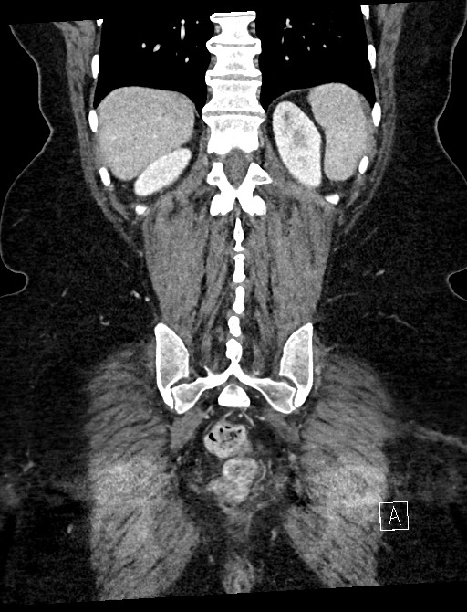Closed loop small bowel obstruction - adhesions (Radiopaedia 59078-66369 B 98).jpg