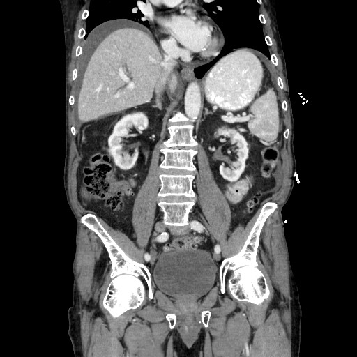 Closed loop small bowel obstruction - adhesive disease and hemorrhagic ischemia (Radiopaedia 86831-102990 B 74).jpg