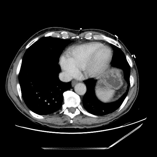 File:Closed loop small bowel obstruction - omental adhesion causing "internal hernia" (Radiopaedia 85129-100682 A 9).jpg