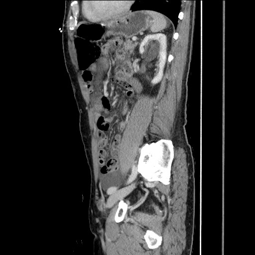 Closed loop small bowel obstruction - omental adhesion causing "internal hernia" (Radiopaedia 85129-100682 C 121).jpg