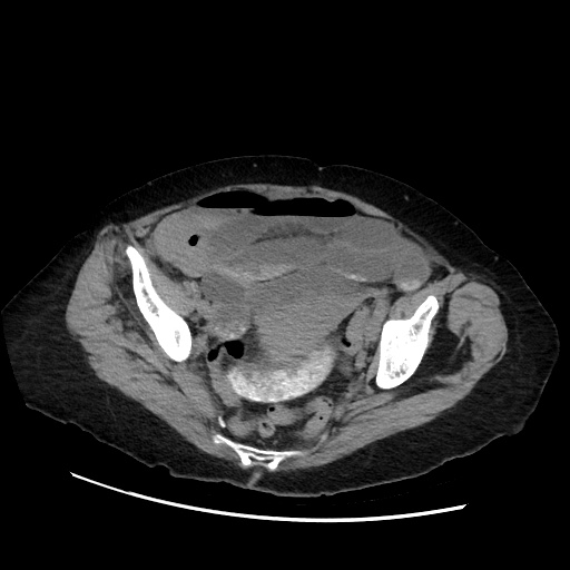 Closed loop small bowel obstruction due to adhesive band, with intramural hemorrhage and ischemia (Radiopaedia 83831-99017 Axial non-contrast 133).jpg