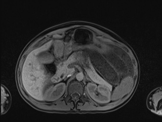 Closed loop small bowel obstruction in pregnancy (MRI) (Radiopaedia 87637-104031 Axial T1 fat sat 39).jpg