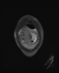 File:Closed loop small bowel obstruction in pregnancy (MRI) (Radiopaedia 87637-104031 Coronal T2 fat sat 11).jpg