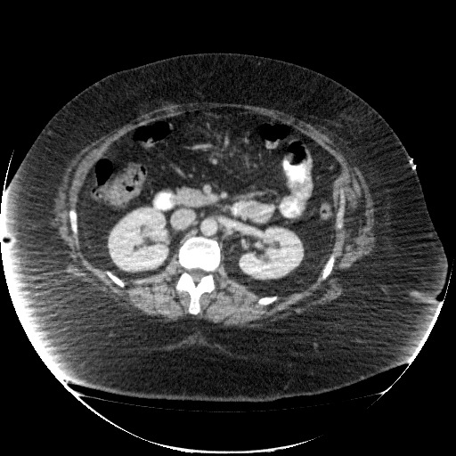 File:Collection due to leak after sleeve gastrectomy (Radiopaedia 55504-61972 A 36).jpg