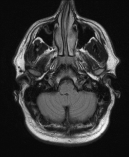 File:Colloid cyst (Radiopaedia 44510-48181 Axial FLAIR 4).png