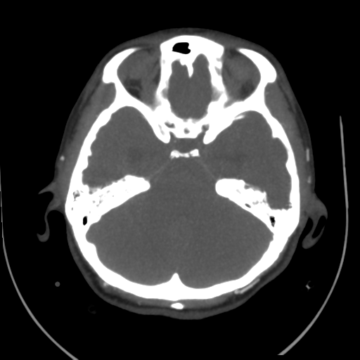 File:Colloid cyst (resulting in death) (Radiopaedia 33423-34499 A 18).png