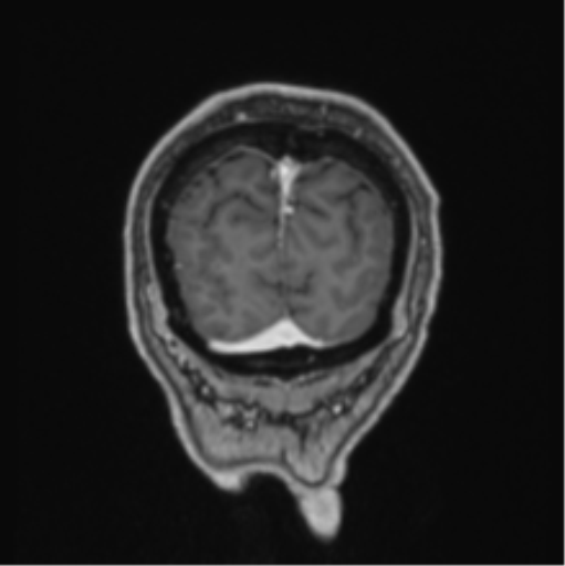 File:Colloid cyst of the third ventricle (Radiopaedia 86571-102662 Coronal T1 C+ 12).png