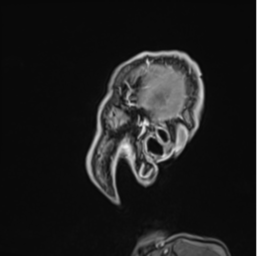 Colloid cyst of the third ventricle (Radiopaedia 86571-102662 Sagittal T1 C+ 74).png