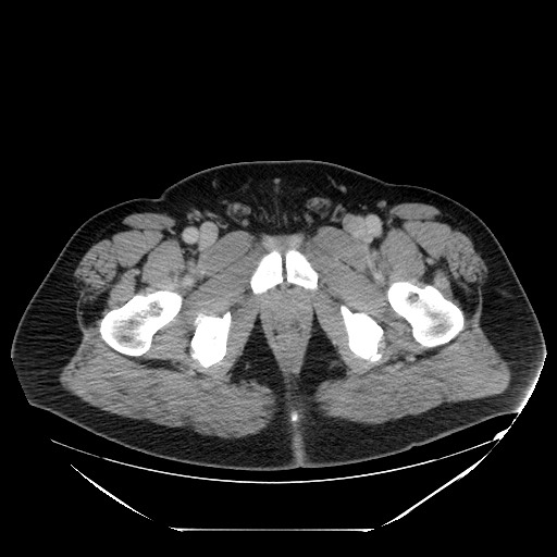 Colocolic intussusception due to lipoma (Radiopaedia 73712-84508 A 119).jpg
