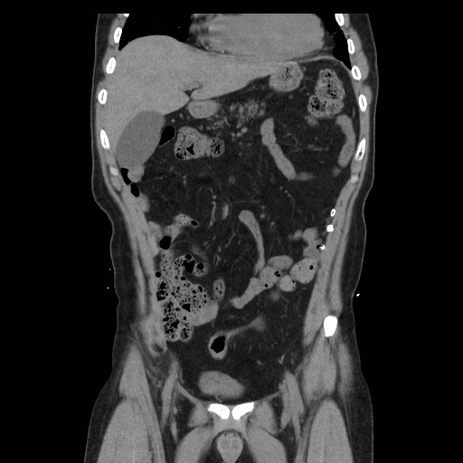 File:Colocutaneous fistula in Crohn's disease (Radiopaedia 29586-30093 Coronal non-contrast 3).jpg