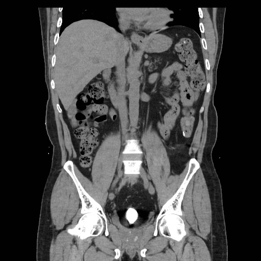 File:Colocutaneous fistula in Crohn's disease (Radiopaedia 29586-30093 E 21).jpg