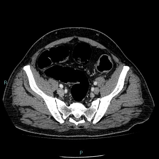 Colon adenocarcinoma with calcific liver metastasis (Radiopaedia 55745-62300 B 36).jpg