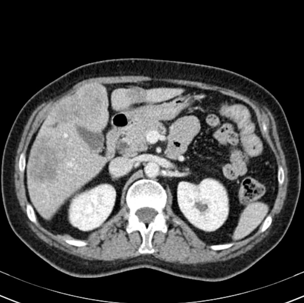 Colon carcinoma with hepatic metastases (Radiopaedia 29477-29961 A 39).jpg