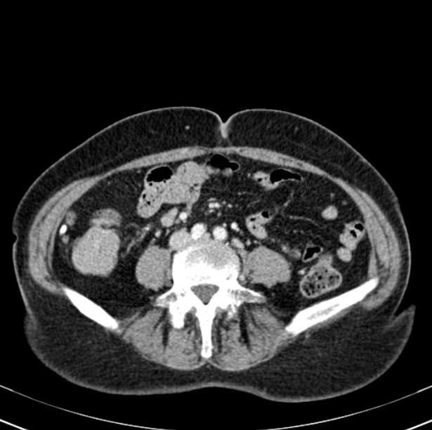 Colon carcinoma with hepatic metastases (Radiopaedia 29477-29961 A 70).jpg