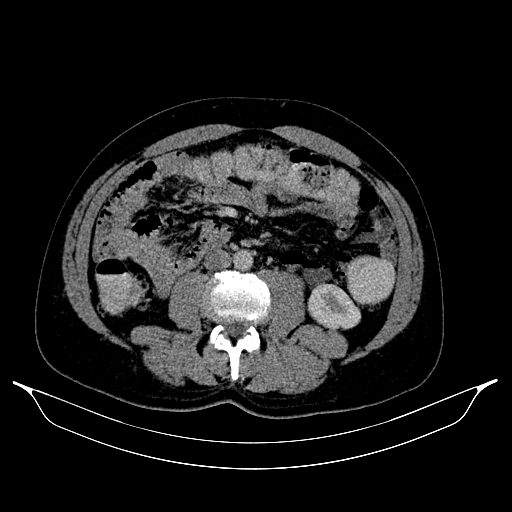 Colonic diverticulosis (Radiopaedia 72222-82744 A 20).jpg
