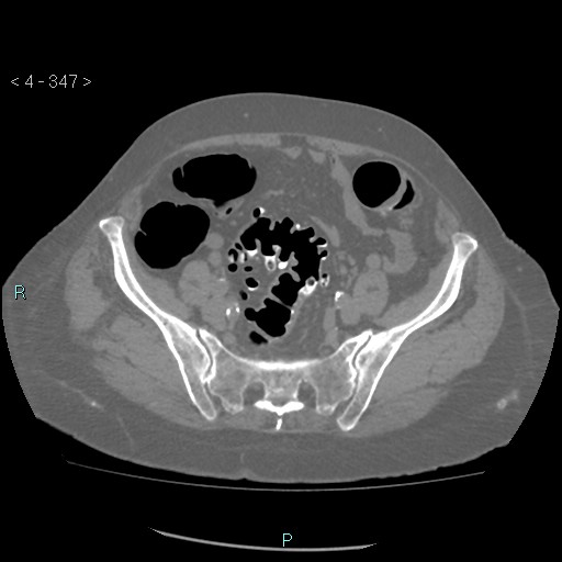 File:Colonic lipomas (Radiopaedia 49137-54244 Axial bone window 155).jpg
