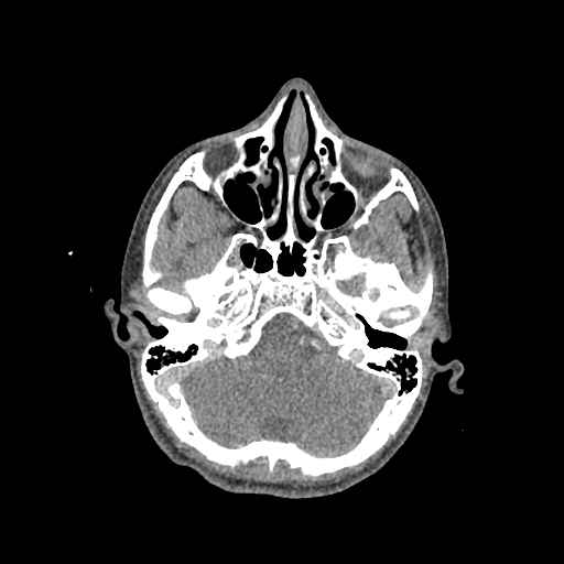 File:Nasal pyogenic granuloma (lobular capillary hemangioma) (Radiopaedia 85536-101244 C 84).jpg