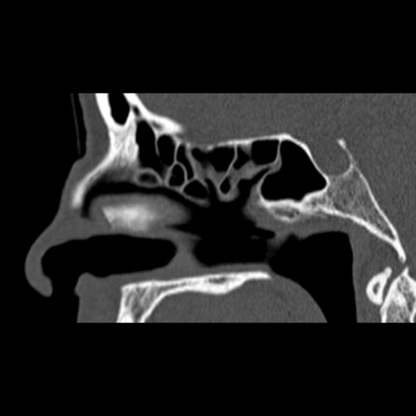 Nasal septal perforation (Radiopaedia 25030-25289 Sagittal bone window 33).jpg