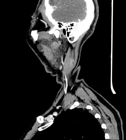 File:Nasopharyngeal carcinoma - infiltrating the clivus (Radiopaedia 62583-70875 C 8).jpg