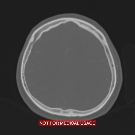 File:Nasopharyngeal carcinoma recurrence - skull base destruction (Radiopaedia 29107-29490 Axial bone window 31).jpg