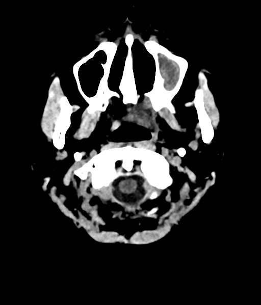 File:Nasopharyngeal carcinoma with cerebral abscess (Radiopaedia 43018-46275 Axial non-contrast 5).png