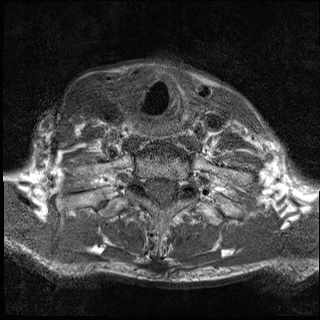 File:Nasopharyngeal carcinoma with skull base invasion (Radiopaedia 59258-66600 Axial T1 16).jpg