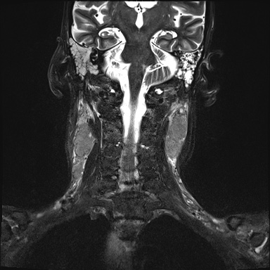 Nasopharyngeal carcinoma with skull base invasion (Radiopaedia 59258-66600 Coronal T2 fat sat 8).jpg
