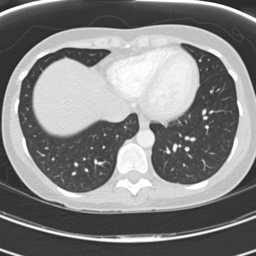 Necrobiotic pulmonary nodules - Crohn disease (Radiopaedia 20723-20631 Axial lung window 108).jpg
