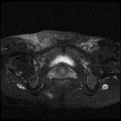 File:Necrotizing epididymo-orchitis with intra-testicular abscess (Radiopaedia 29397-29860 Axial T2 fat sat 4).jpg