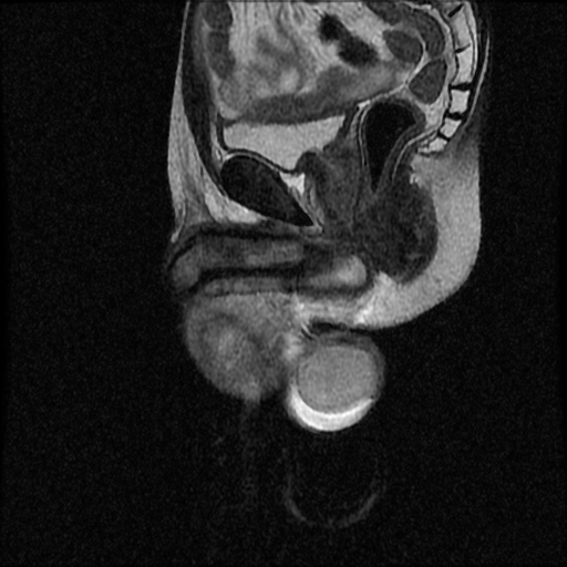 File:Necrotizing epididymo-orchitis with intra-testicular abscess (Radiopaedia 29397-29860 Sagittal T2 10).jpg