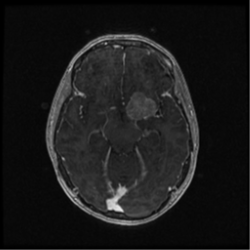 Neurofibromatosis type 2 (Radiopaedia 45229-49244 Axial T1 C+ 55).png