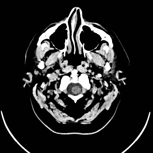 Neurofibromatosis type 2 (Radiopaedia 79097-92047 Axial non-contrast 2).jpg
